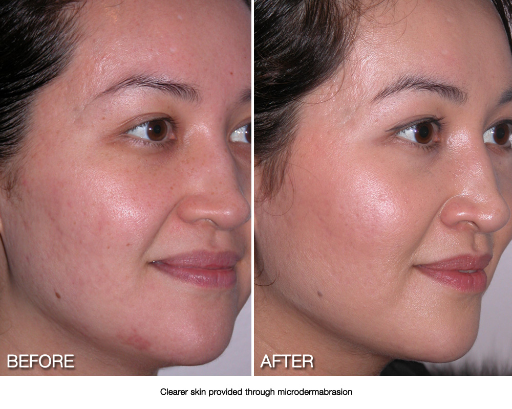 Microdermabrasion Renew Laser and Skin Clinic