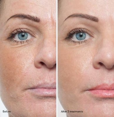 Microdermabrasion