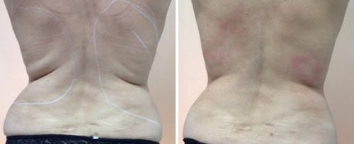 TightSculpting
